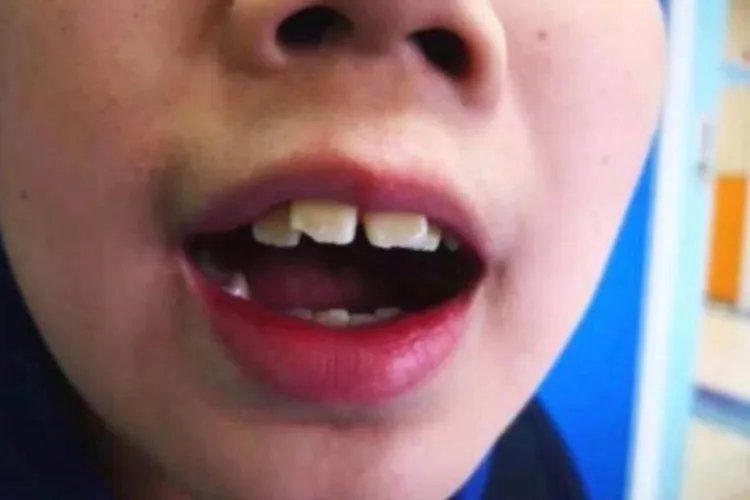 儿童腺样体面容图片