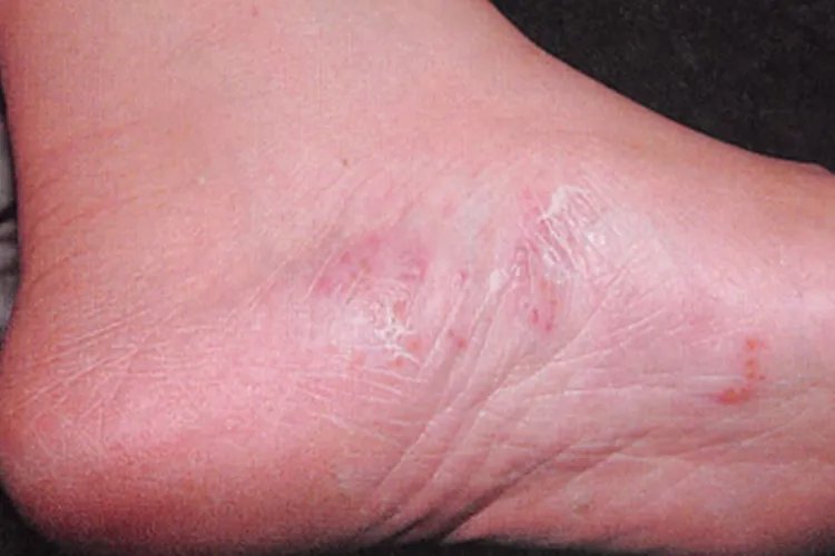 脚上起癣的图片和症状