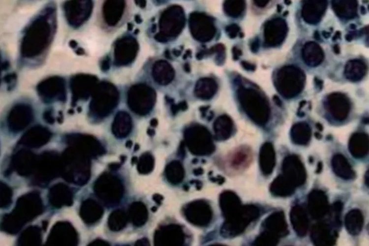 癌细胞真实图片