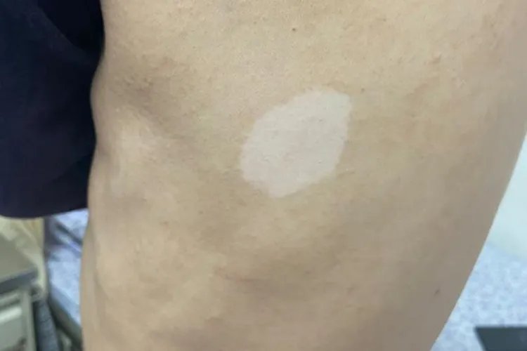 小孩身上有白斑图片