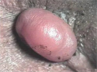 外痔症状图片