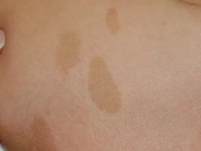 咖啡斑症状图片