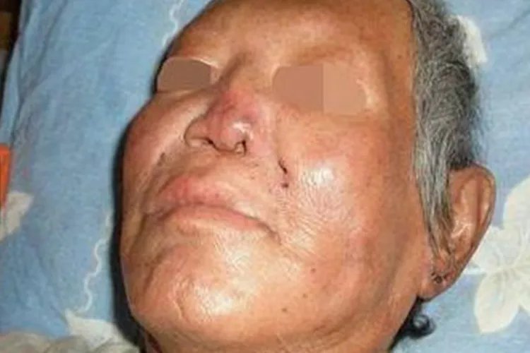 麻风病是什么病及图片