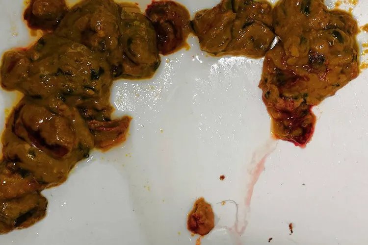 肠癌大便形状图样