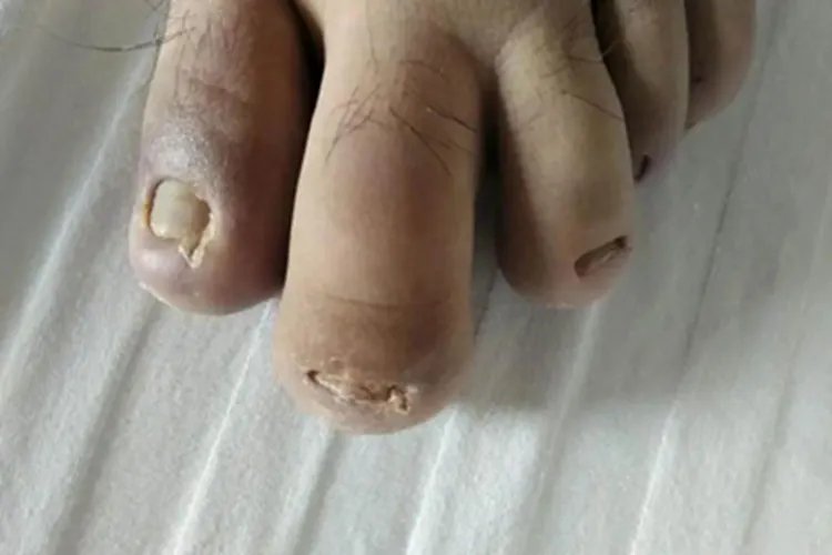 肢端肥大症症状图片