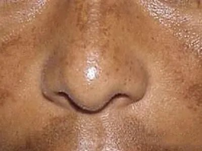 家族性进行性色素沉着症斑图片