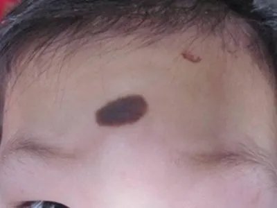 咖啡斑症状图片