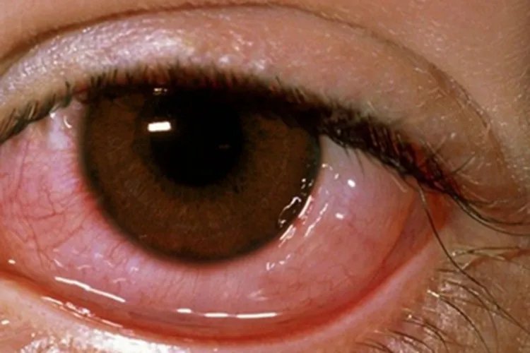 登革热症状图片