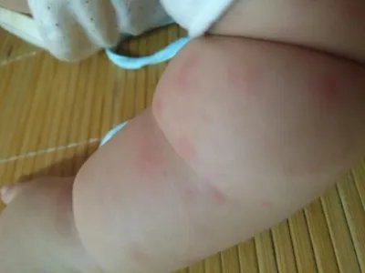 勒-雪病症状图片