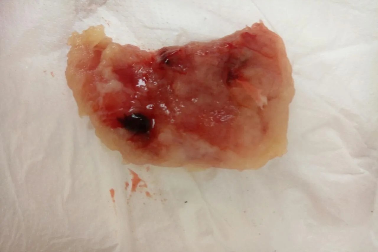 孕囊排出来是什么样子图片