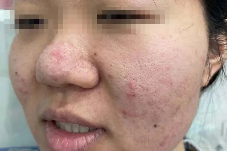 脸的两侧发红还有小疙瘩图片