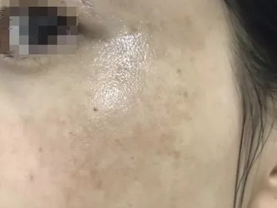 家族性进行性色素沉着症斑图片