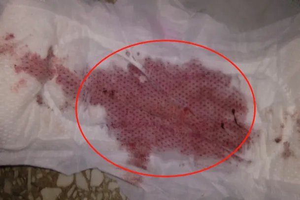 正常大姨妈血的图片