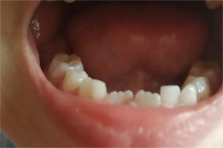 门牙边缘锯齿状图片