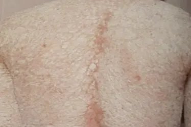 火棉胶婴儿真实图片