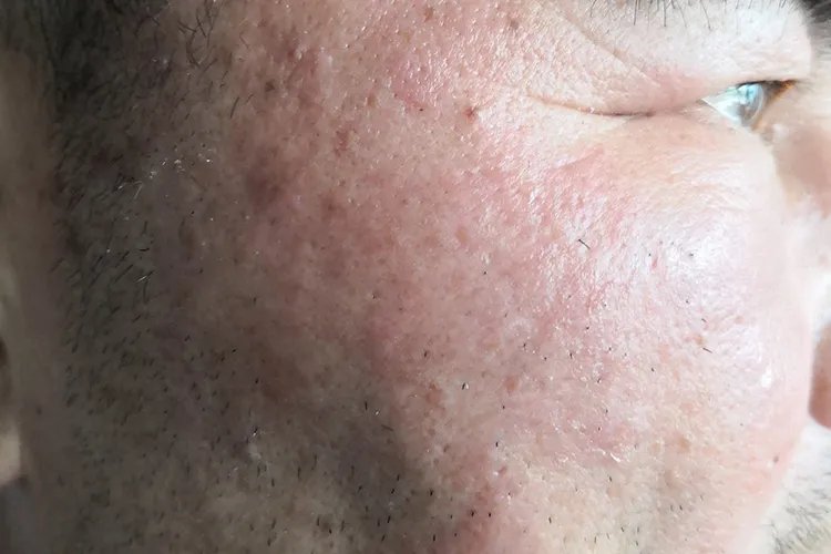 丹毒的症状图片