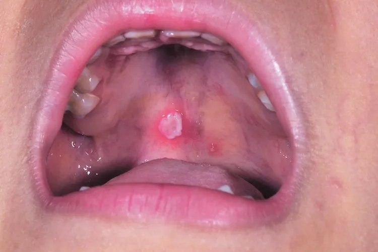 手足口病轻微图片