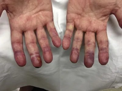 冷凝集素综合征手指尖皮肤发紫图片