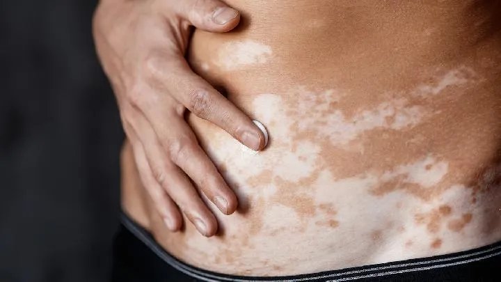 目前已知白癜风的危害有哪些?