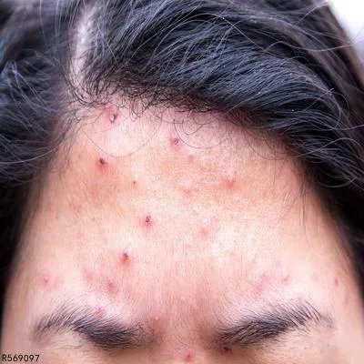 如何快速祛痘的妙招学生