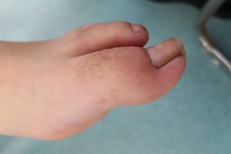 丹毒的症状图片