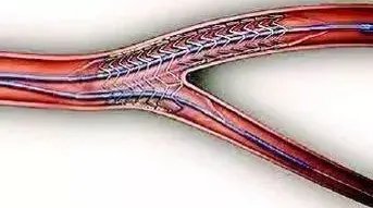 装支架就废了?北京安贞医院心内科专家带您走出误区!!
