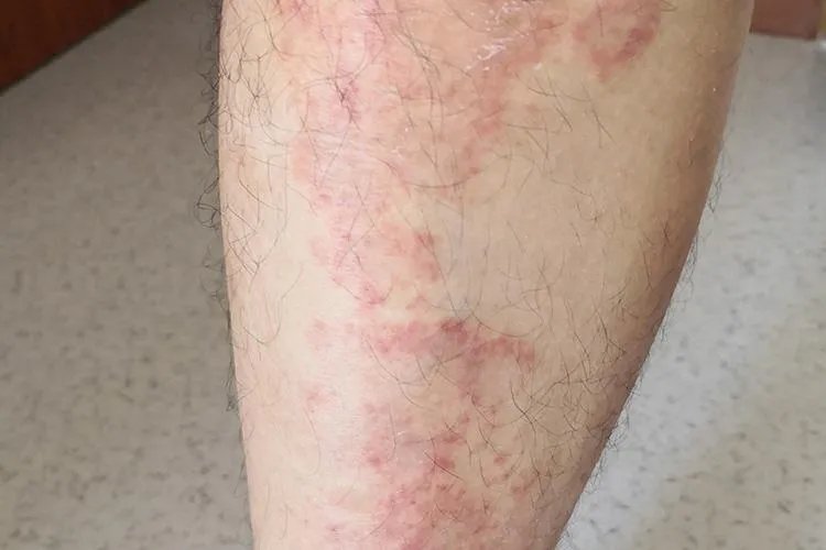 腿上长了一片红癣图片