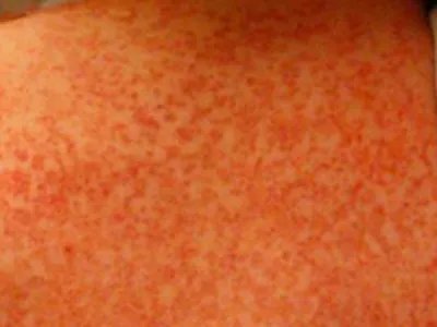 勒-雪病症状图片