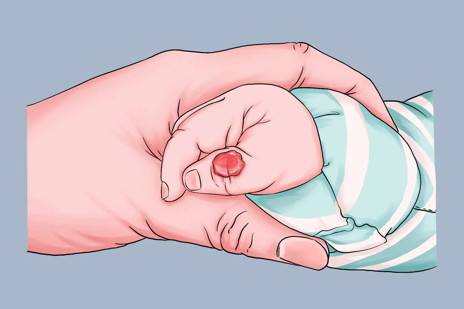 大拇指血管瘤图片