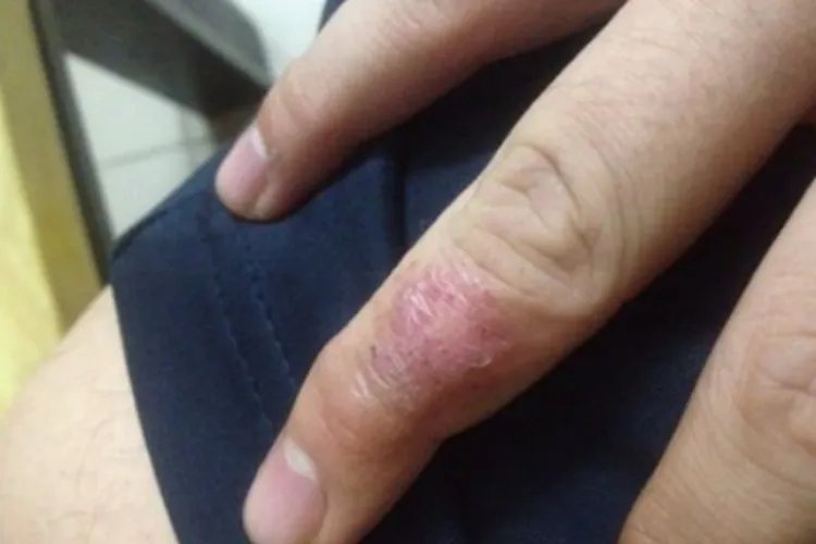 手癣图片初期症状图片大全