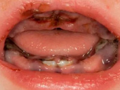 勒-雪病症状图片