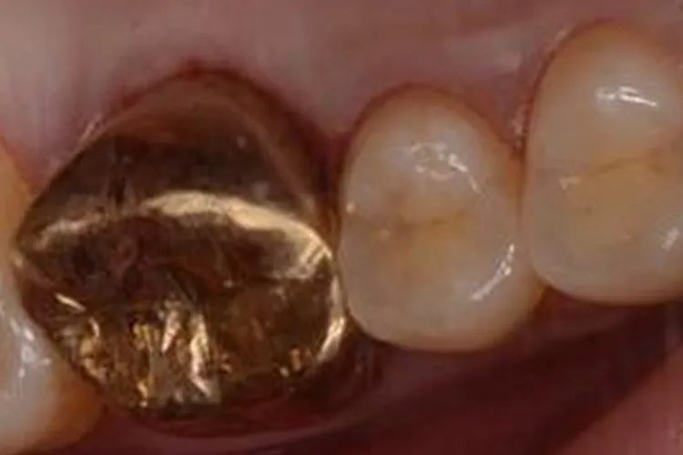 单颗牙套的图片