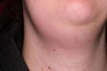 女性大脖子病前兆图片