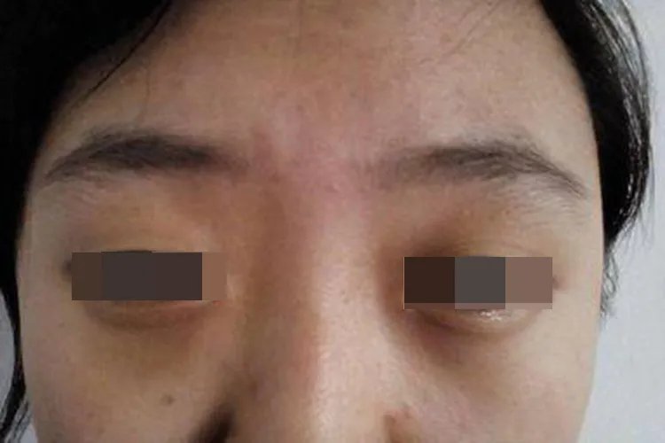 失眠黑眼圈图片