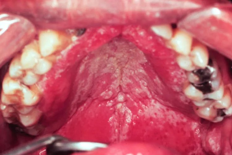 口腔白色念珠菌图片