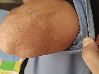 咖啡斑症状图片