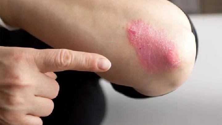 手癣对身体影响大吗