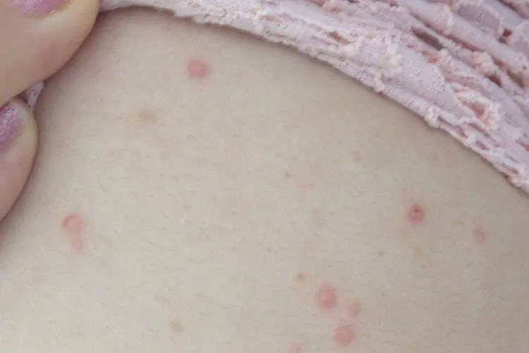 背部常见皮炎图片大全
