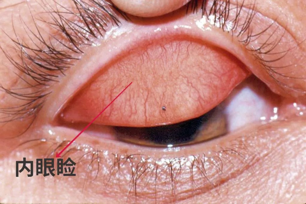 内眼睑是哪里图解