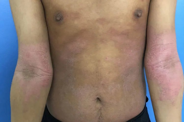 皮炎图片和症状