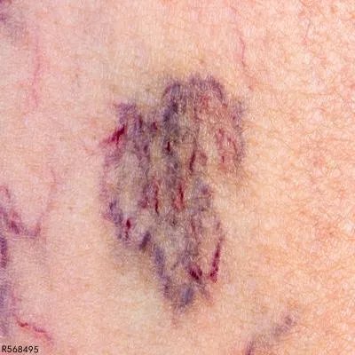 紫癜性肾炎初期症状有哪些 警惕初期紫癜性肾炎的三个症状