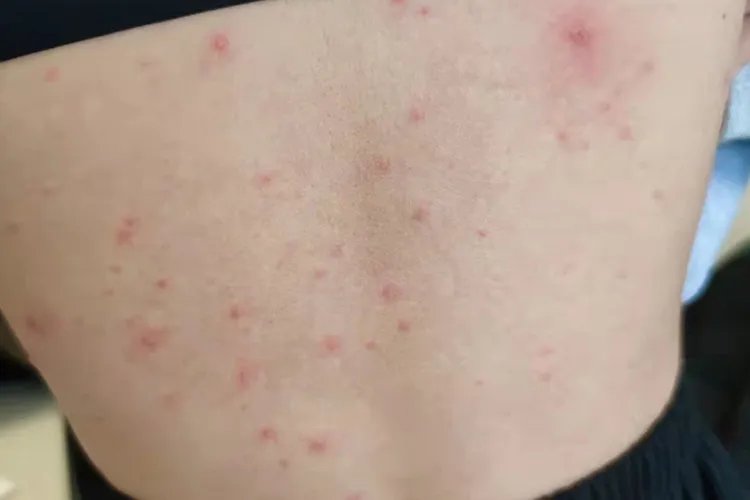 什么是水痘图片大全