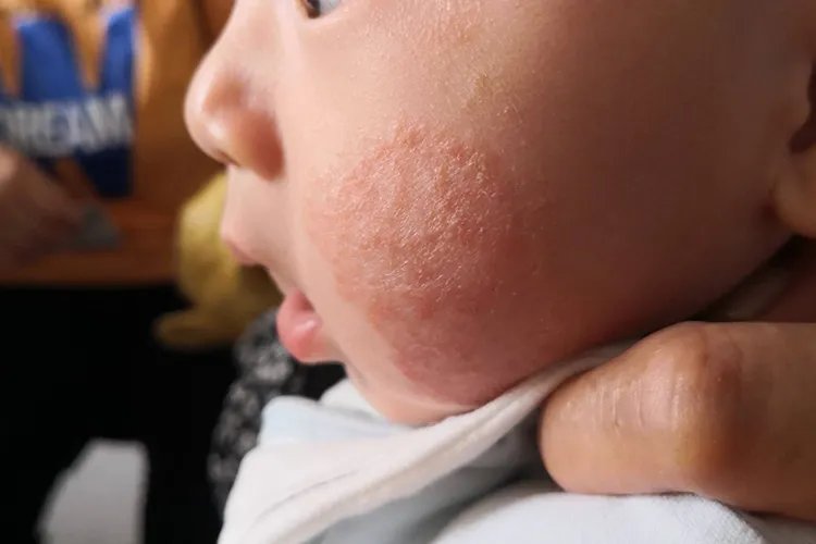 皮炎图片和症状