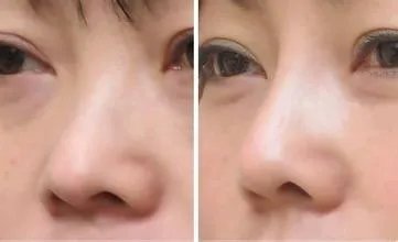 做鼻头缩小手术多少钱？