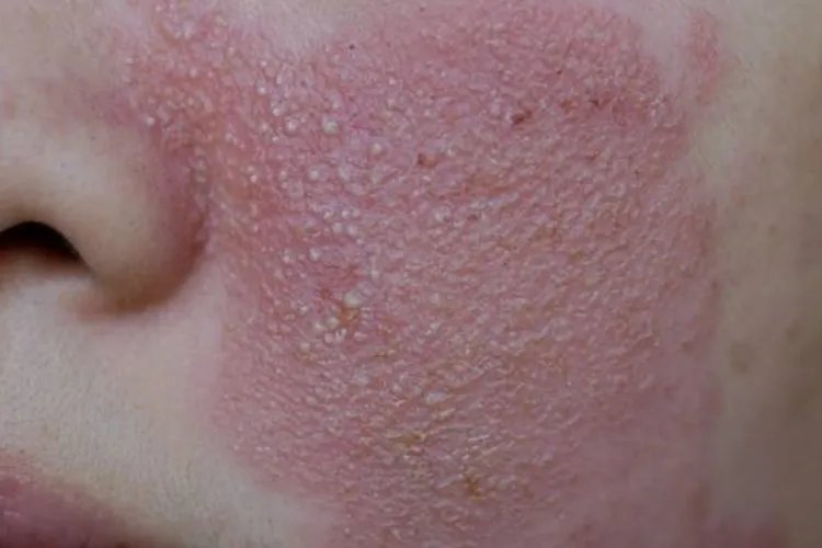 皮炎图片和症状