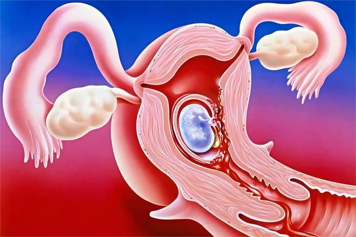 孕囊在宫腔位置分布图