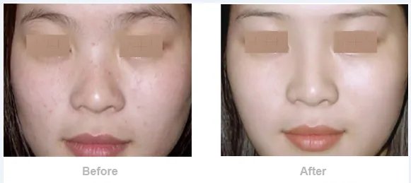 成都手术矫正歪鼻美容整形医院有哪些名单_口碑哪里好点击一览