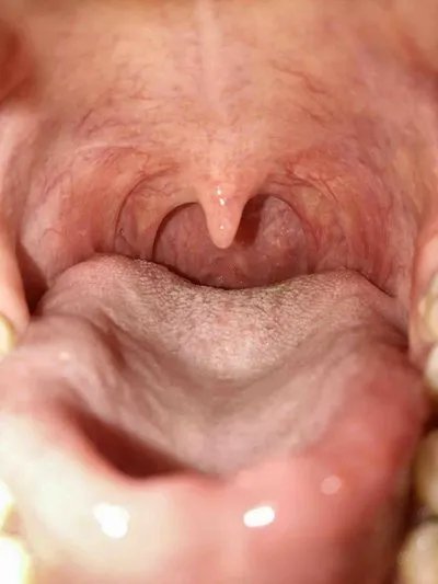 舌头痛是什么原因?