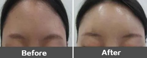 苏州好的丰额头整形医院在哪？