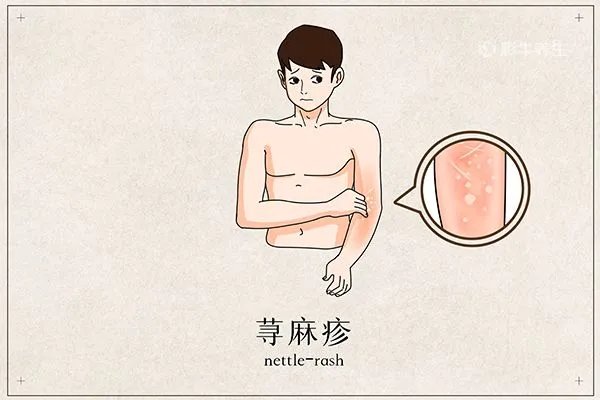 荨麻疹初期症状图片 荨麻疹的早期症状有哪些